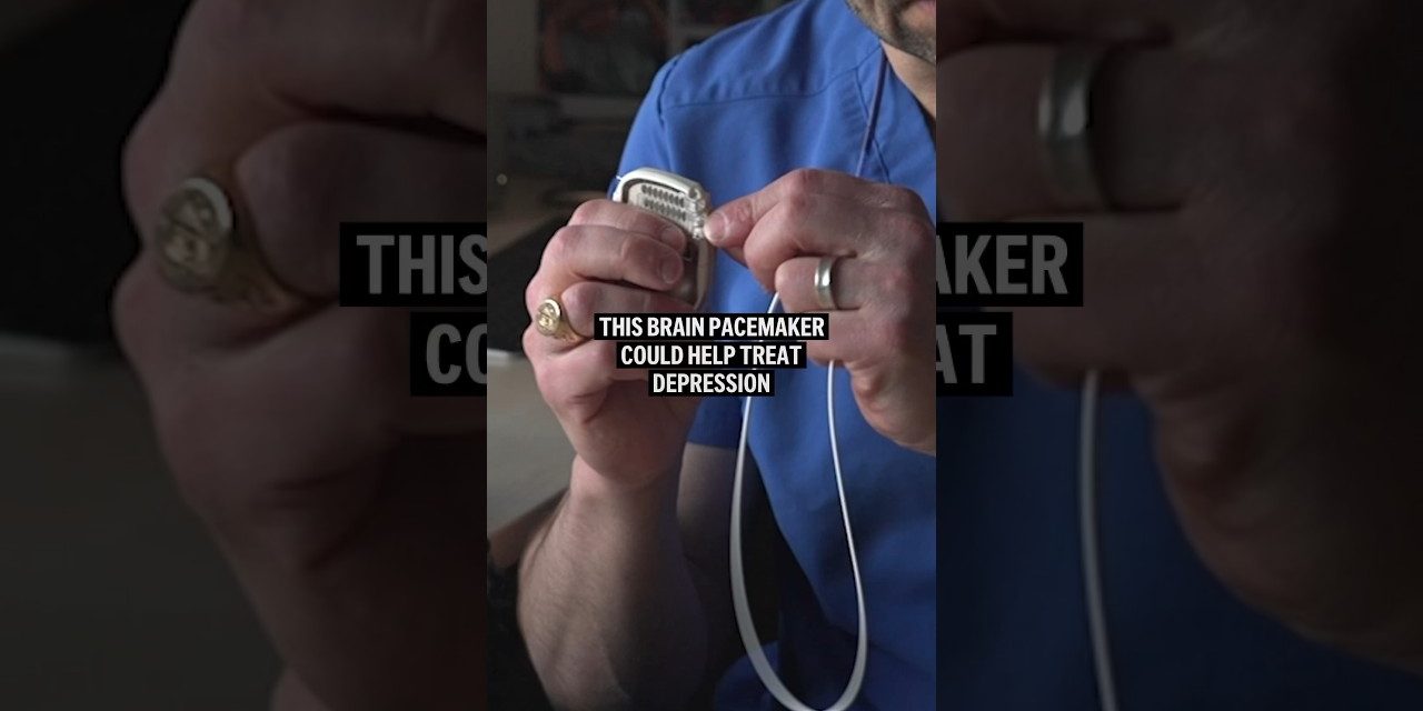 Brain Pacemaker Dapat Mengobati Berbagai Gangguan Neurologis