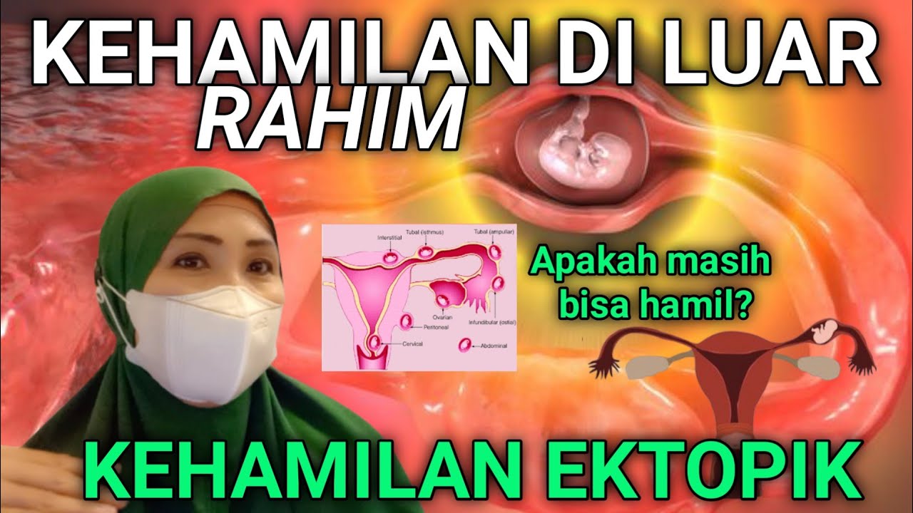 Kehamilan Di Luar Rahim