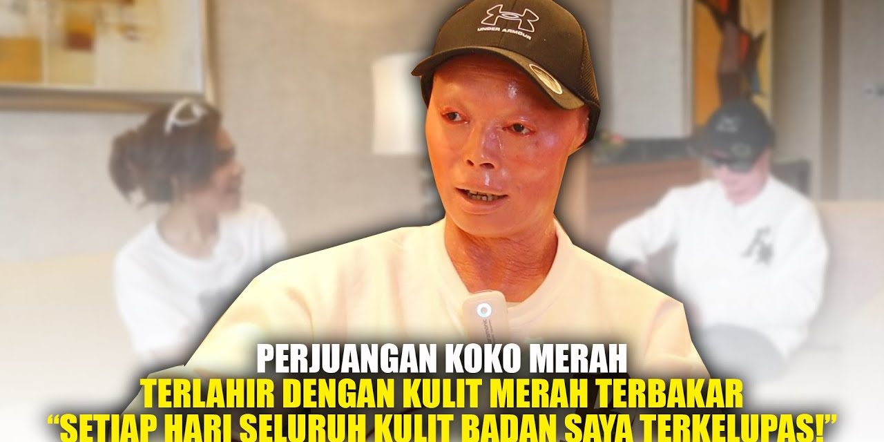 Koko Merah Tetap Semangat Meskipun Menderita Penyakit Langka
