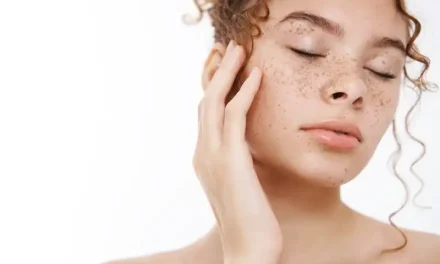 Flek Hitam Di Wajah: Penyebab, Solusi, Dan Cara Pencegahan